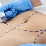 Cirurgia plástica abdominal