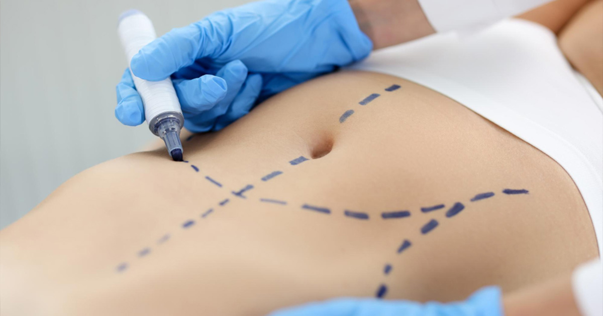 Cirurgia plástica abdominal