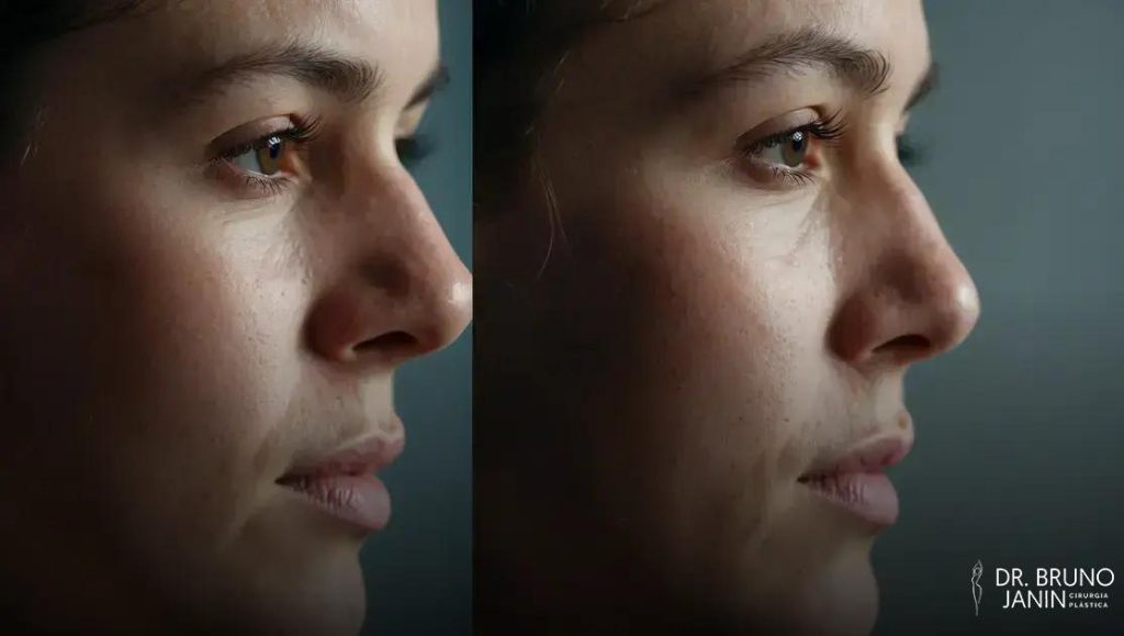 Pode fazer otoplastia duas vezes? entenda quando repetir o procedimento pode ser seguro