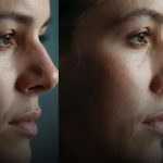 Pode fazer otoplastia duas vezes? entenda quando repetir o procedimento pode ser seguro