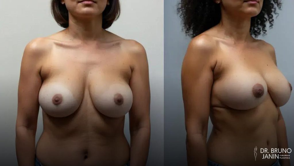 Blog 2 Como saber se preciso de mastopexia ou mamoplastia? descubra o que cada cirurgia oferece