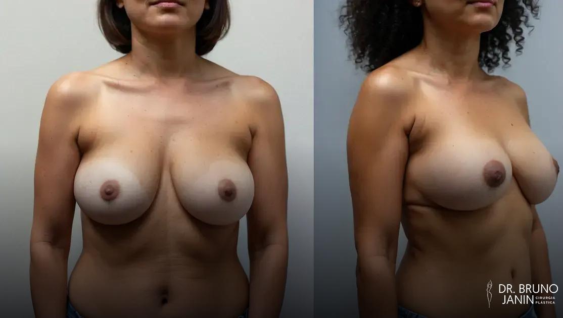 Como saber se preciso de mastopexia ou mamoplastia? descubra o que cada cirurgia oferece