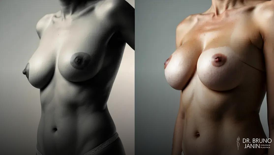 Como saber se preciso de mastopexia ou mamoplastia? Descubra o que considerar